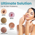 Non-Invasive Acne & Wart Removal Laser Pen with Heating (No Side Effect)