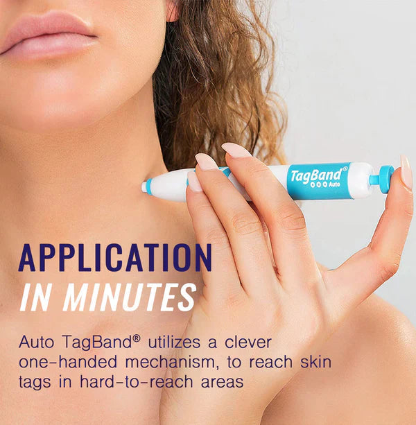 Skin Tag Remover Device For Medium To Large Skin Tags