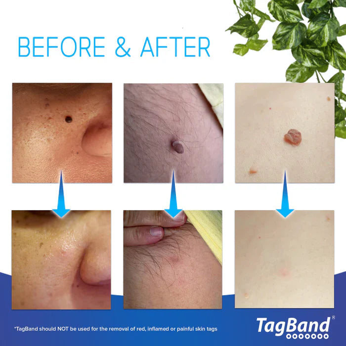 Skin Tag Remover Device For Medium To Large Skin Tags